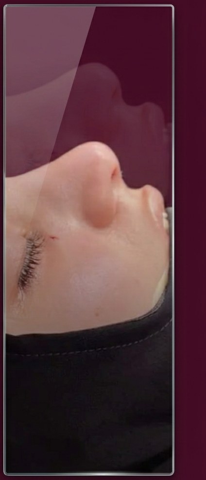 After preservation rhinoplasty, profile view, patient 1