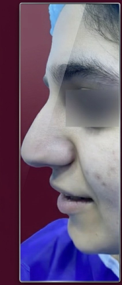 Before preservation rhinoplasty, profile view, patient 1
