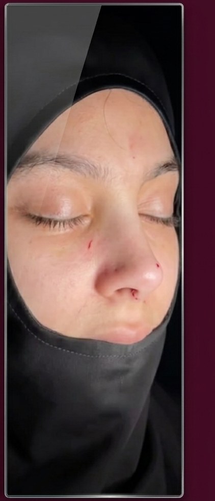 After ethnic rhinoplasty, profile view, patient 2