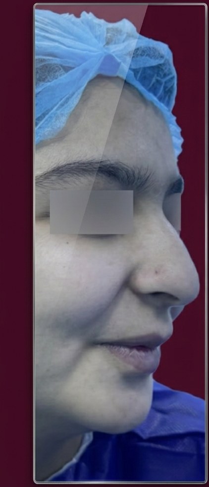 Before ethnic rhinoplasty, profile view, patient 2