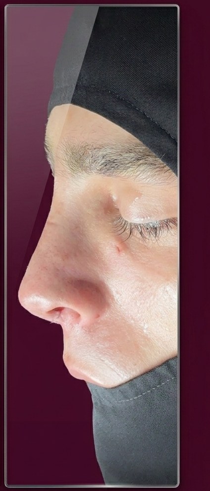 After structural refinement rhinoplasty, profile view, patient 3