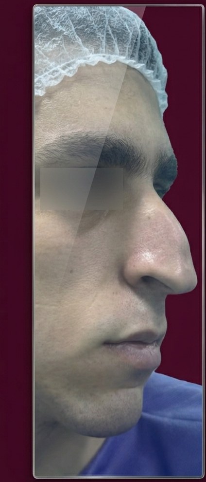 Before structural refinement rhinoplasty, profile view, patient 3