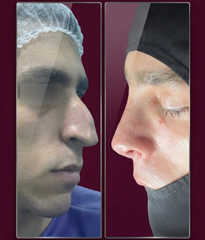 Before and after preservation rhinoplasty, profile view, patient 3
